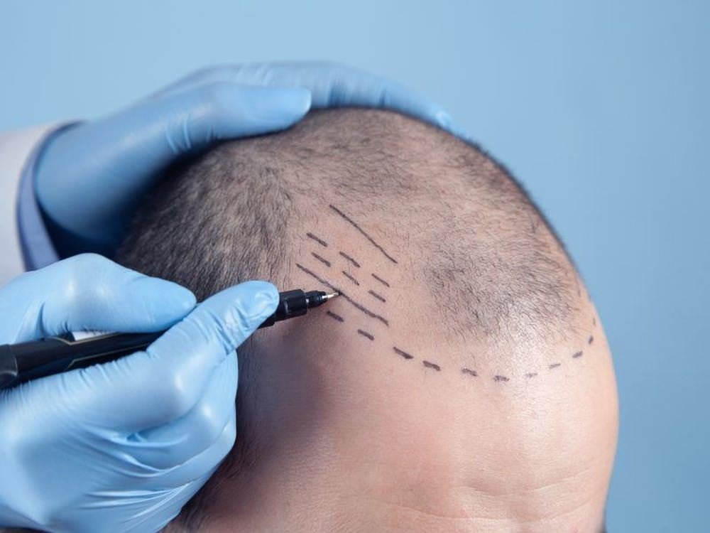 Hair Transplant
