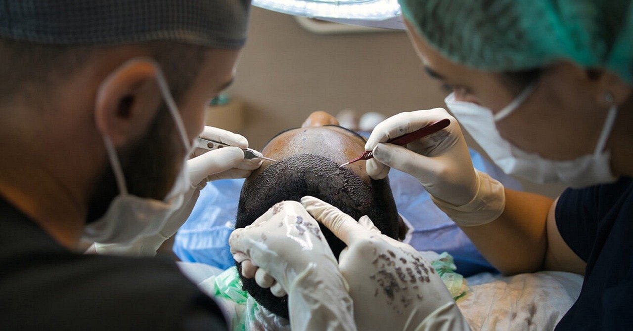 hair transplant in Jaunpur